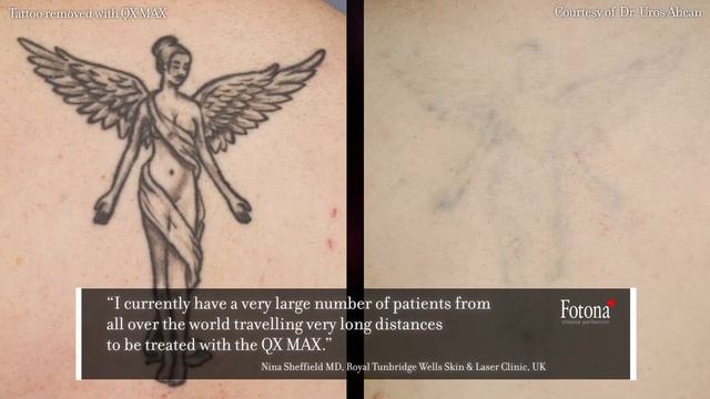 Laser tattoo and pigmented lesions removal with QX MAX смотреть онлайн