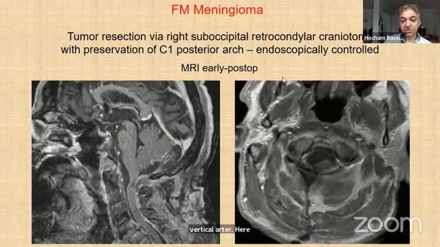 Treatment of foramen magnum meningiomas/PD Dr. Med. Hischan Bassiouni смотреть онлайн