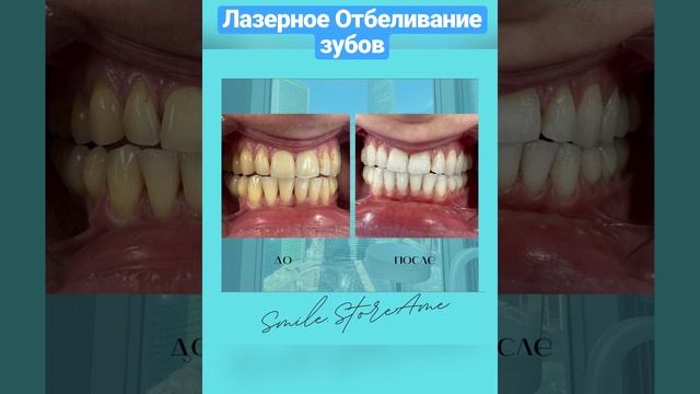 Кабинет стоматологии, Лазерное отбеливание зубов, обработка под лазером каждый зуб в отдельности! смотреть онлайн