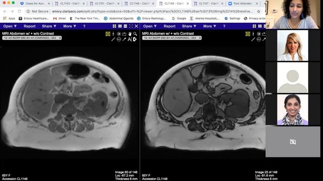 Adrenal adenoma pitfall in a patient with clear cell RCC - Dr. Aarti Sekhar смотреть онлайн