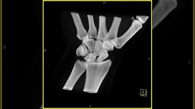 Wrist Anatomy: 3D VRT CT смотреть онлайн