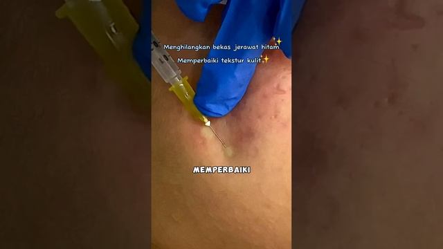 ERIKA BERHENTI BUAT KONTEN MAKAN, TAPI KARENA KLINIK DERMA EXPRESS, GAJADI !! #dermaexpress #acne смотреть онлайн
