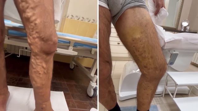 Клинический случай во флебологии: Эндовенозная лазерная коагуляция + минифлебэктомия смотреть онлайн