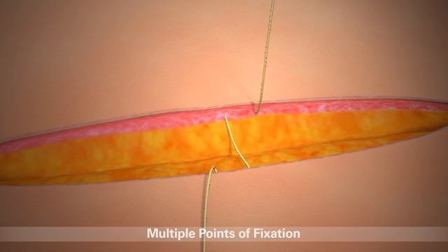 STRATAFIX Product Overview Animation CA смотреть онлайн