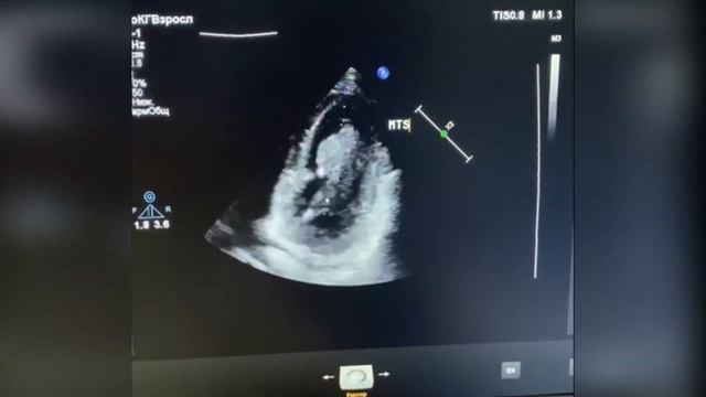 86. Метастазы в сердце (три образования) metastases in the heart. смотреть онлайн