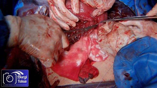 Placenta Accreta part 3 (October 2023) смотреть онлайн