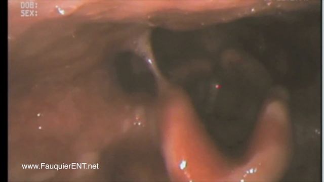 Epiglottitis Appearance Over Time (Supraglottitis) смотреть онлайн