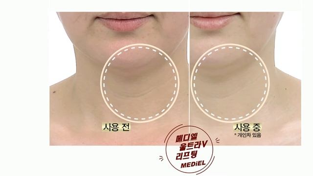 메디엘 울트라V리프팅 세럼 Mediel Ultra V Lifting Serum смотреть онлайн