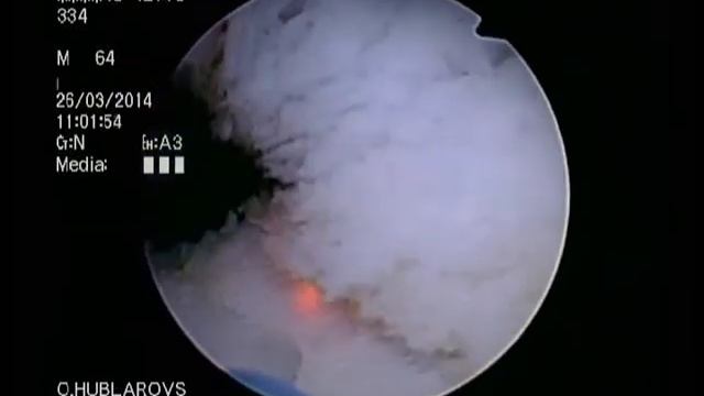 HoLEP,Part 3.Holmium Laser Enucleation of the Prostate (HoLEP) Median lobe enucleation. смотреть онлайн