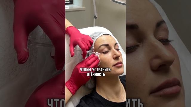 Синяки под глазами как убрать #косметолог #синяки смотреть онлайн