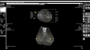 Обучающее видео "Разметка маммограмм"