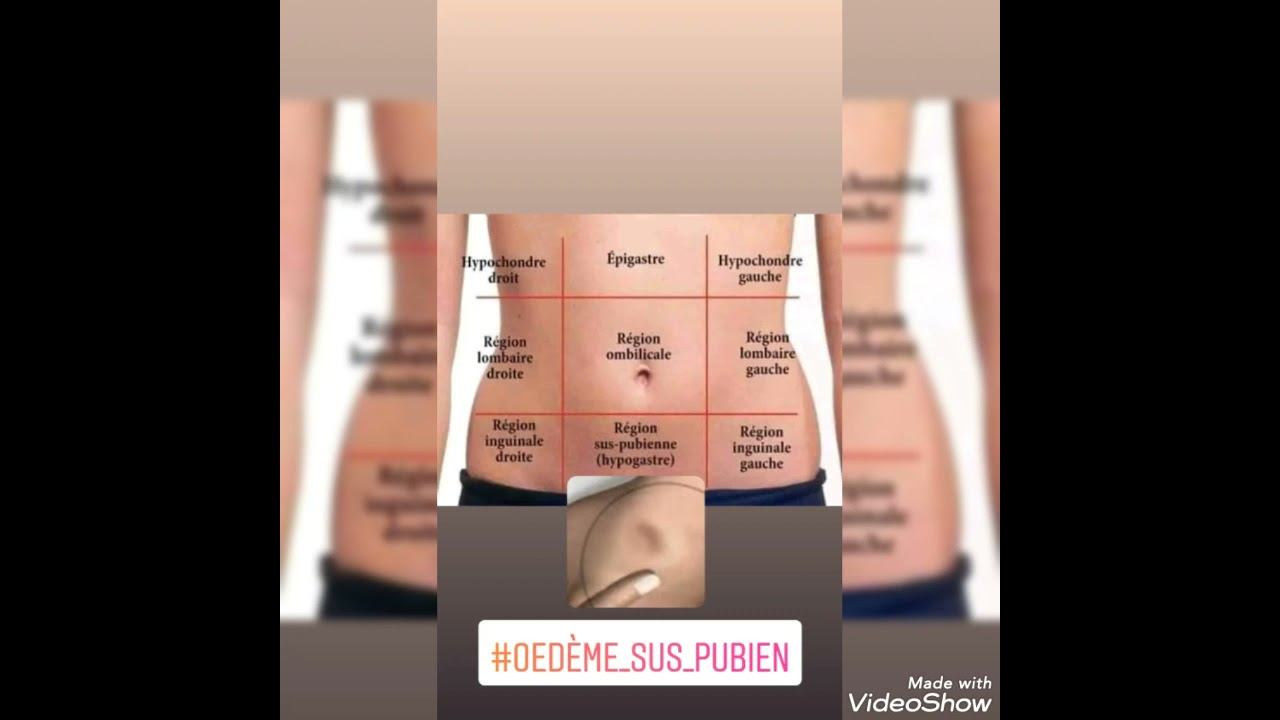 Les œdèmes 🦶👐🤰 احتباس #الماء смотреть онлайн