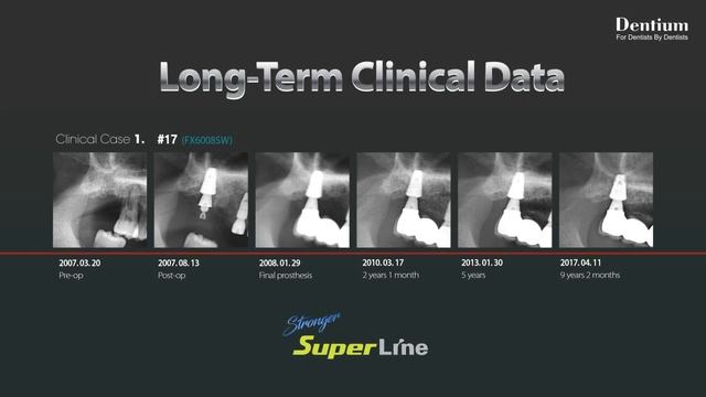 New SuperLine (Higher Strength & Joint Stability) + 2018 Dentium Forum in Thailand смотреть онлайн