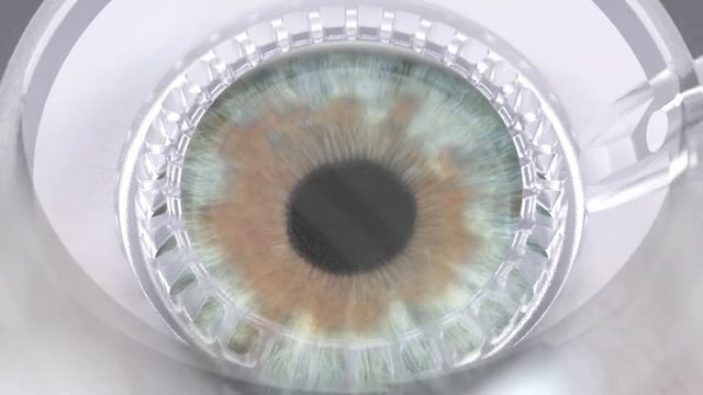 Laserová operácia očí novým laserom VISUMAX 800 смотреть онлайн