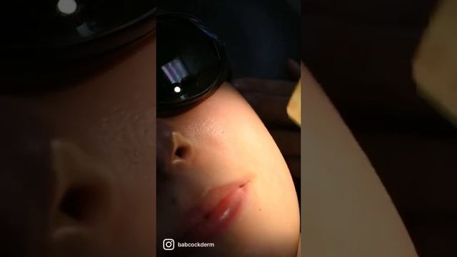 IPL Treatment at Babcock Dermatology смотреть онлайн