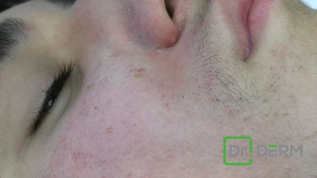 Blackhead Extravaganza | Dr. Derm смотреть онлайн