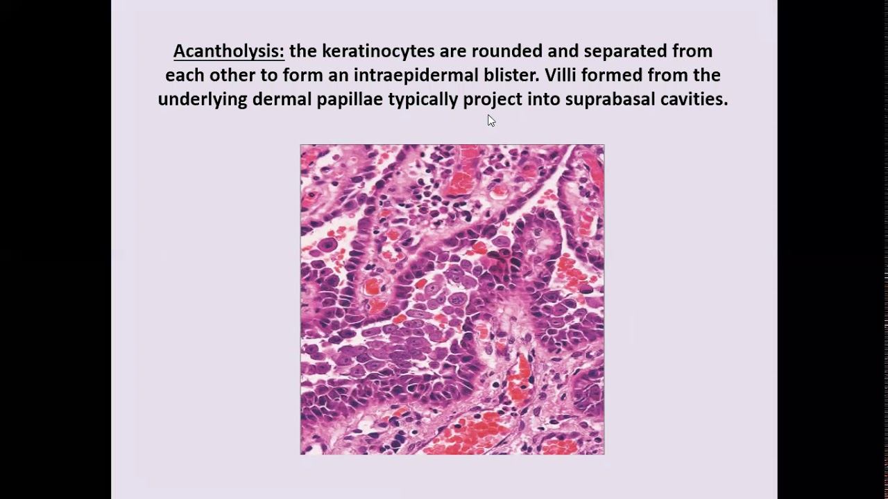 Lecture-46: Pemphigus group of diseases, Part I. Rook's chapter 50. смотреть онлайн
