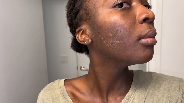 Perfect Derma Peel Journey (Chemical Peel for Hyperpigmentation +Acne) + Before and After Pics смотреть онлайн