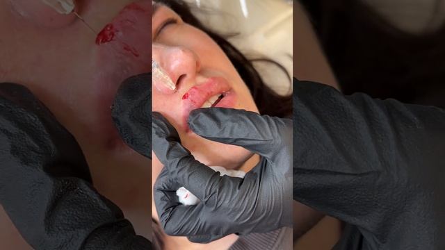 Увеличение губ ( филлер Stilage) губы 👄 смотреть онлайн