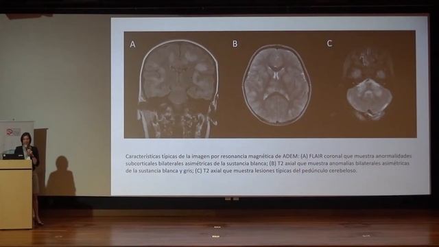 03 Dra. Evelyn Lora (Actualización en Encefalomielitis Diseminada Aguda) смотреть онлайн