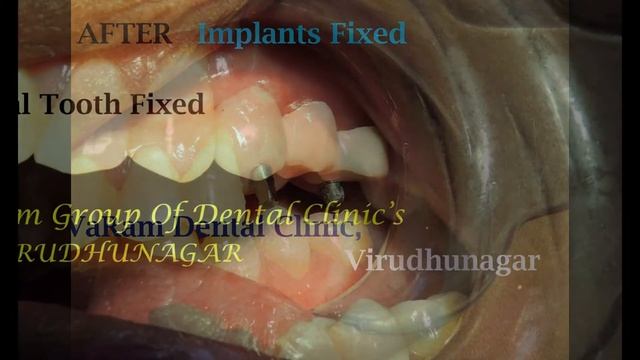 INDIRECT SINUS LIFT WITH IMPLANTS смотреть онлайн