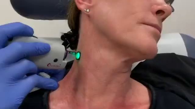 VBeam Perfecta pulse dye laser treatment for sundamage on chest and neck (Poikiloderma of Civatte) смотреть онлайн