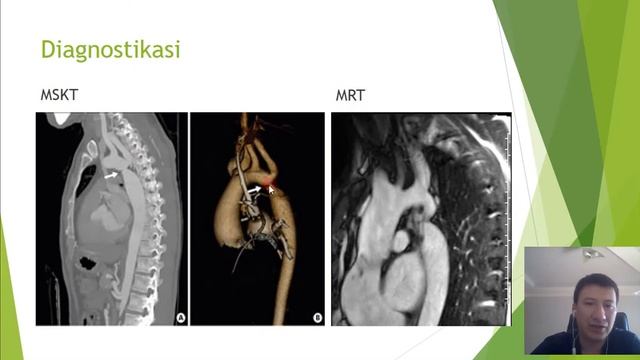 Yurak tug'ma nuqsoni. Aorta Koarktatsiyasiyasi (Коарктация аорты) смотреть онлайн