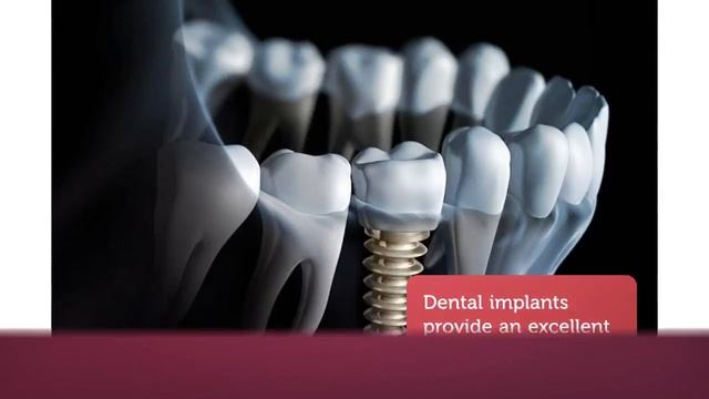 Dental Implants in Rochester, NY смотреть онлайн