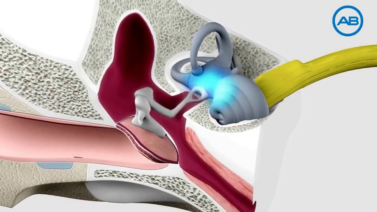 How A Cochlear Implant Works by Advanced Bionics смотреть онлайн