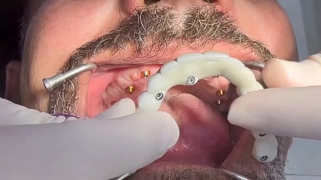 All on 6 implant смотреть онлайн