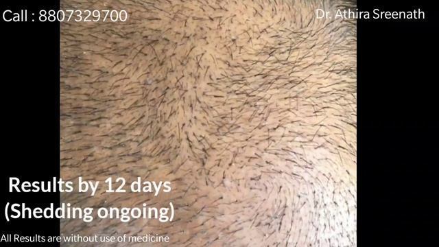 Hair Transplant | First 2 months | Shedding phase | Donor Area Coverage | Dr.Athira Sreenath смотреть онлайн