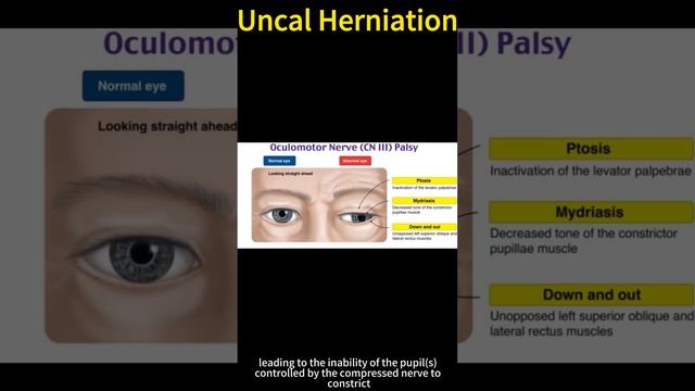 Uncal Herniation смотреть онлайн