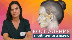 Воспаление тройничного нерва