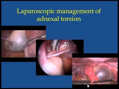 Complications of Ovarian Stimulation смотреть онлайн