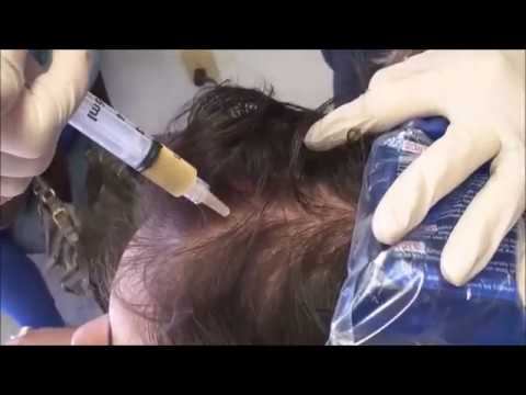 PRP Procedure смотреть онлайн