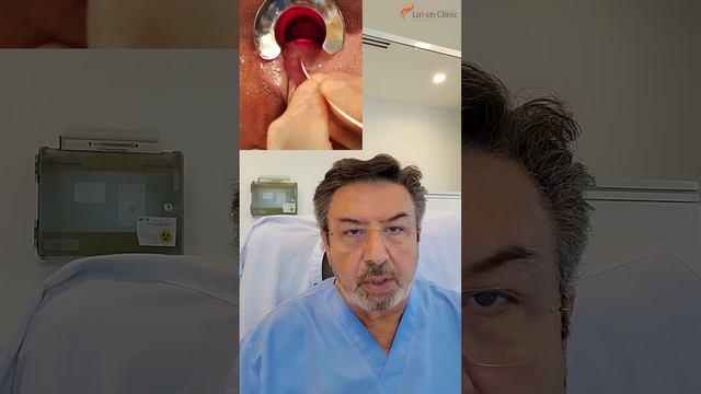 Hemorrhoids Treatment By Advanced Laser - Same day in few minutes - Laven Clinic смотреть онлайн