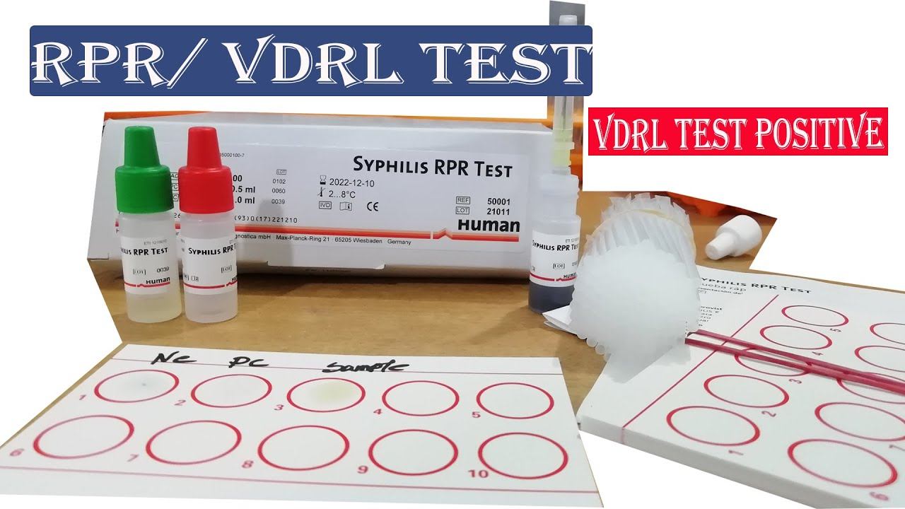 VDRL TEST/ SYPHILIS TEST/RPR TEST Procedure. смотреть онлайн