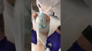 Вальгус (перевязка)