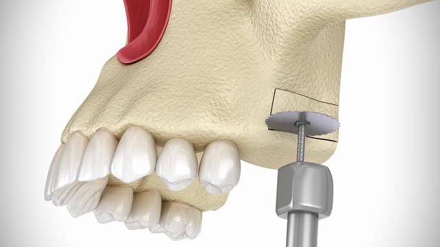 Missing Teeth & Bone Loss? Safe Sinus Lift Surgery Explained- Maltepe Dental Clinic in İstanbul смотреть онлайн
