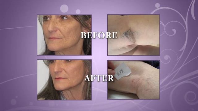 DermaHealth-2 Client Testimonials Commercial смотреть онлайн