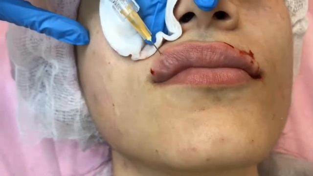 Контурна пластика у Лвові ( Збільшення об’єму губ ) смотреть онлайн
