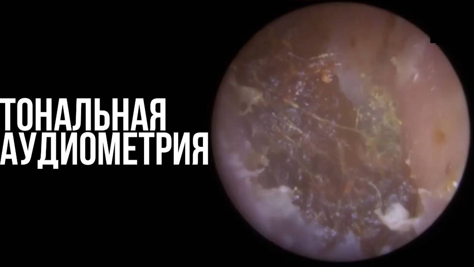 Тональная аудиометрия смотреть онлайн