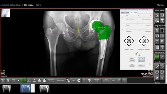 Radlink3D and Siemens Cios Spin: The Future of 3D Imaging in Orthopedic Surgery смотреть онлайн