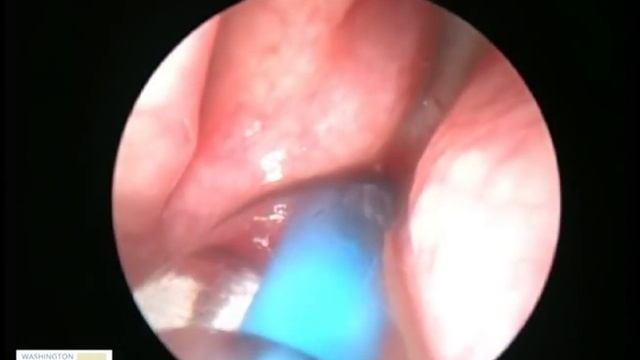 Office XprESS dilation of the sphenoid sinus ostium under local anesthesia смотреть онлайн