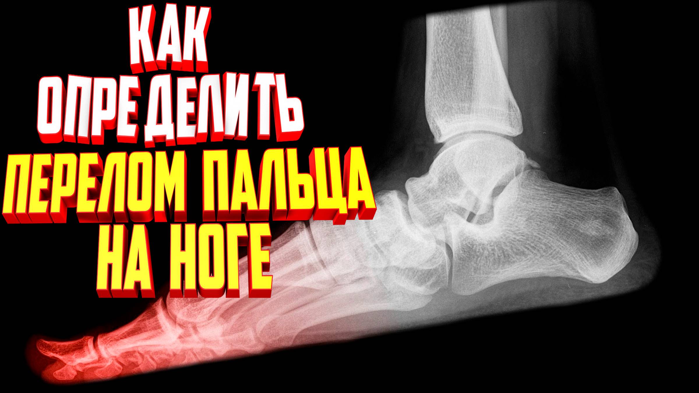 Как определить перелом пальца на ноге. 3 признака смотреть онлайн