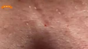 Удаление прыщей с носа и щек Spa G #044
