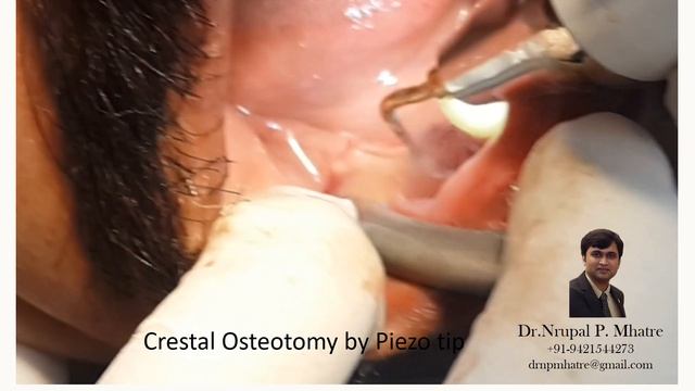 Ridge Split Surgery with Peizotome смотреть онлайн