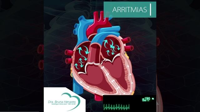 Arritmia - Taquicardia supraventricular смотреть онлайн