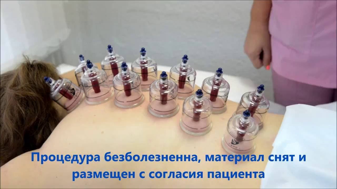 Лечение вакуумными банками смотреть онлайн