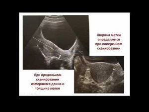 УЗИ матки в норме